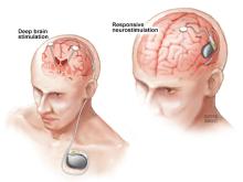 brain surgery epilepsy